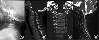 Cervical spine involvement in pediatric mucopolysaccharidosis patients: Clinical features, early diagnosis, and surgical management